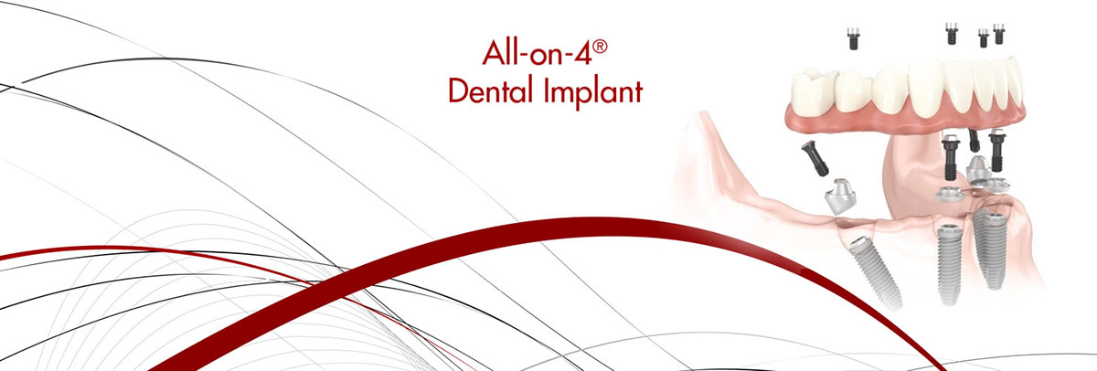 West Roxbury All-on-4 Dental Implants