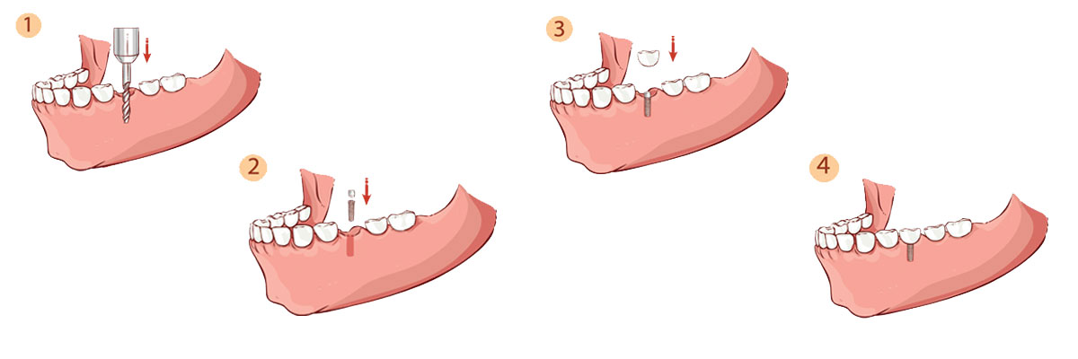 West Roxbury The Dental Implant Procedure