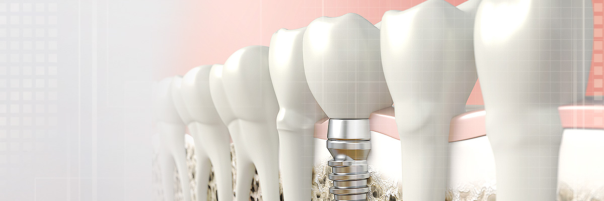 West Roxbury Implant Dentist