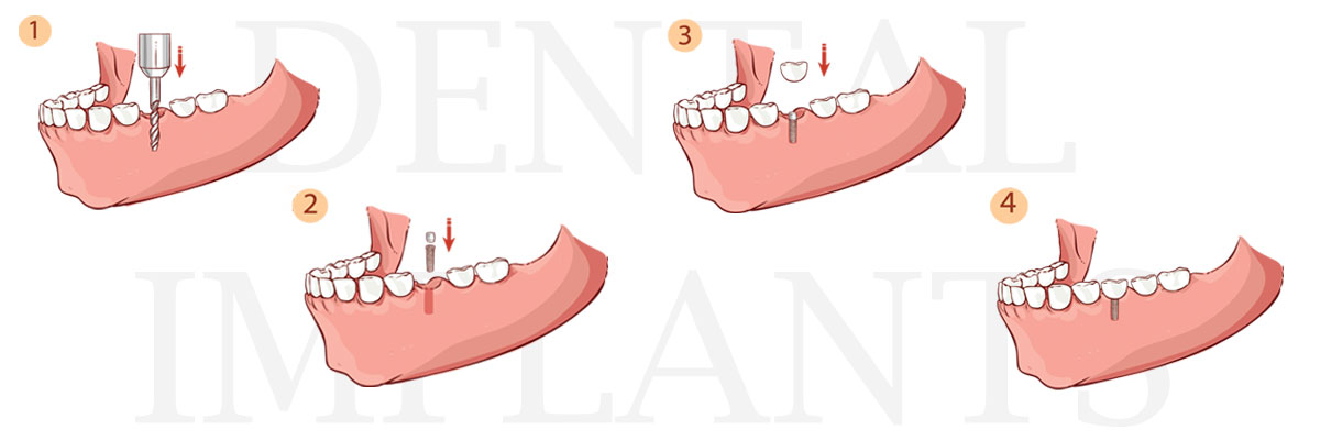 West Roxbury The Difference Between Dental Implants and Mini Dental Implants