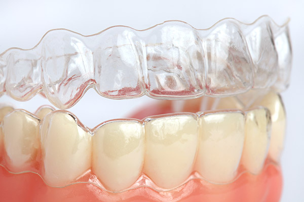 Invisalign® Braces: Facts About the Process