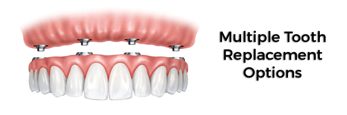 West Roxbury Multiple Teeth Replacement Options