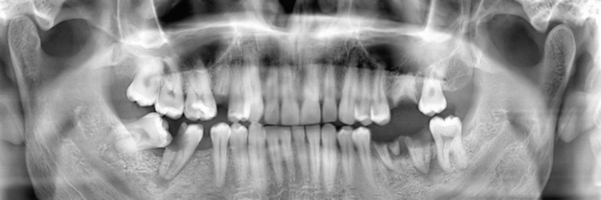 West Roxbury Options for Replacing Missing Teeth