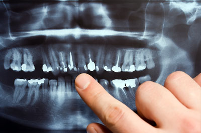 Wisdom Teeth Extraction