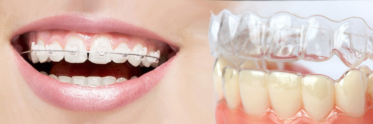 West Roxbury Which is Better Invisalign or Braces
